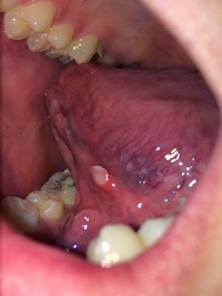の 出来 ベロ 物 裏 舌の裏が痛い原因は？舌癌の可能性や対処方法を紹介！