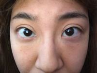 全切開しました これは完全に失敗ですよね 日々悩まされてます Yahoo 知恵袋