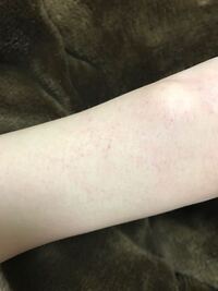 最近よく小さな内出血のようなものが顔や腕にでき 1 2日程度ですぐに消失 Yahoo 知恵袋