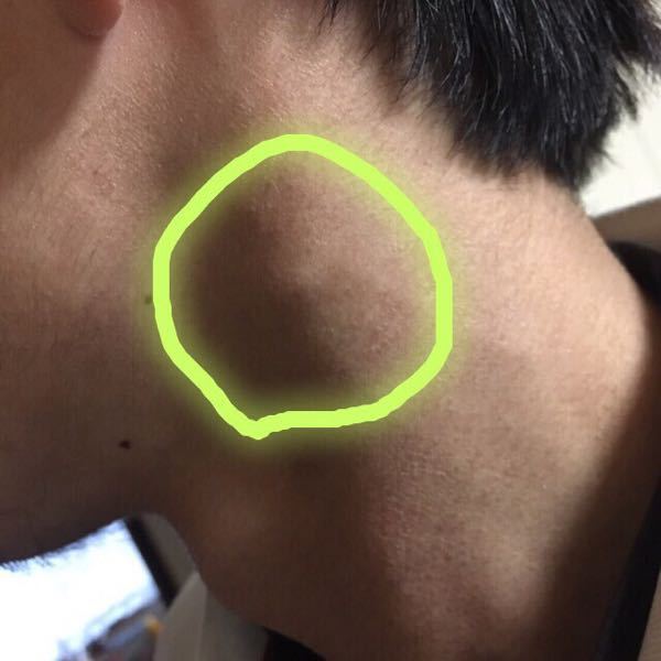22歳の男です。首にしこりがあります。最近全身蕁麻疹のようなブ 
