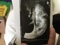 出血がつづいてます 妊娠初期 約6週ごろです 3月7日あたりに Yahoo 知恵袋