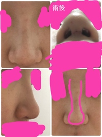 鼻骨骨折をしたことがある方教えてください 鼻骨骨折してたら鼻のところは Yahoo 知恵袋