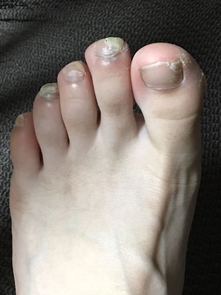 ハンドボールをしています かなり前からですが 爪が剥がれそうです Yahoo 知恵袋