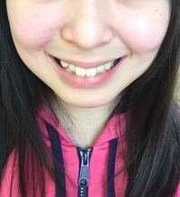 ほうれい線が左右非対称なことについて こんにちは 高校2年の女子で Yahoo 知恵袋