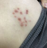 閲覧注意です 胸の下の部分に赤いぶつぶつができました 最 Yahoo 知恵袋