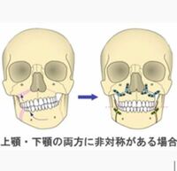 私は左右非対称の顎変形症です 写真でみるとよく分かります 過去に一 Yahoo 知恵袋