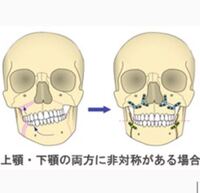 私は左右非対称の顎変形症です 写真でみるとよく分かります 過去に一 Yahoo 知恵袋