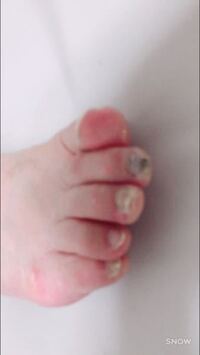 画像はお父さんの足の爪の写真なんですけど 水虫がひどいです 私にも Yahoo 知恵袋