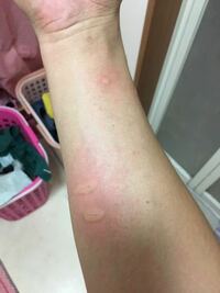 猫 アレルギー 症状
