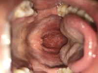 これは扁桃腺の腫れでしょうか 微熱が続いています 微熱 扁桃腺内科 Yahoo 知恵袋