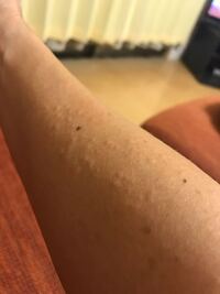 日焼け止めによるかぶれ 日曜日に初めて あるメーカーの日焼け止めを Yahoo 知恵袋