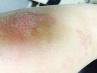 閲覧注意グロいです 以前転んで膝にキズパワーパッドつけて治し Yahoo 知恵袋