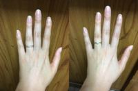 結婚指輪のサイズについて

先日、注文していた結婚指輪が手元に来ました。 待っている間、結婚式準備の参考にとインスタグラム等でいろいろと写真を見ていたのですが、皆さん細い指に綺麗に指輪を着けていて･･･。
いざ私が手元に来た指輪をはめてみると、肉が乗って「ワンサイズ大きくてもよかったんじゃないか？」と思ってしまいました。

注文時（５月ごろ）にはちゃんとリングゲージでサイズを測りま...