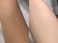 日焼けをしてしまったら 元の白い肌に戻るまでどれくらいかかりますか Yahoo 知恵袋