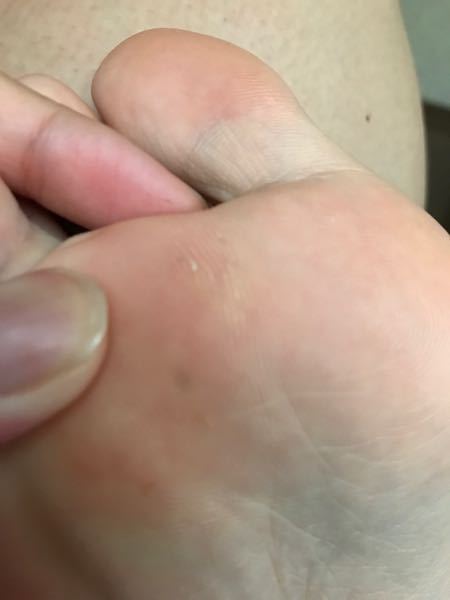 足の裏に茶色いシミのようなものができました これは 病院にいくべきでしょ Yahoo 知恵袋