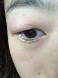 朝起きたら目がこの画像のようになっていました 瞼が凄いはれてい Yahoo 知恵袋