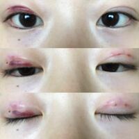 昨日二重の埋没をしました 喫煙者なのですが 煙草を吸うと内出血の治 Yahoo 知恵袋