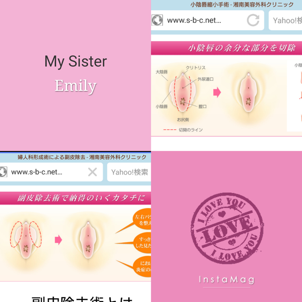 副皮と小陰唇の違いがわかりません。小陰唇はビラビラのヒダですよ 