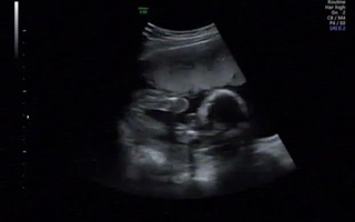 性別判断お願いします ２０週４日のエコーにておまたのあたりに三 Yahoo 知恵袋