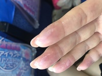 これはやけどのあとの水ぶくれでしょうか 昨日の朝 ヘアアイロンで指をやけ Yahoo 知恵袋