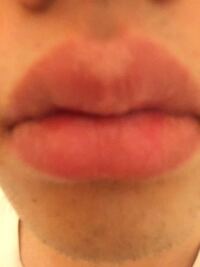 最近上唇の真ん中が白く色素が抜けているのに気づきました 特に痛みもなくか Yahoo 知恵袋