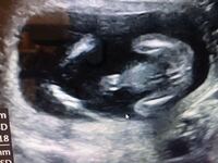 17週のエコー写真ですが 男の子と女の子どっちだと思いますかー Yahoo 知恵袋