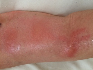 昨日の夜 足の甲に少しピリピリした痛みがありましたが我慢できる Yahoo 知恵袋