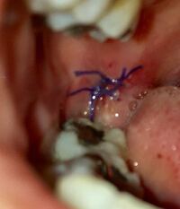 画像注意 親知らず抜歯後の経過と縫合糸について 10日前に右下の Yahoo 知恵袋