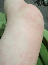 お風呂に入ると皮膚の所々が赤くなります なぜでしょうか お風呂に入ったり Yahoo 知恵袋