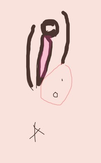 陰部の毛嚢炎について 画像アリ 陰部の毛嚢炎について質問です 旦那と性行 Yahoo 知恵袋