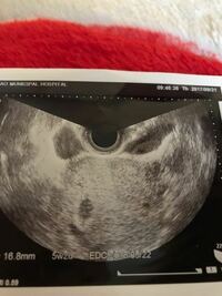 妊娠5wのエコーについて 胎嚢とは別にもう一つ 胎嚢の右隣に小さな Yahoo 知恵袋