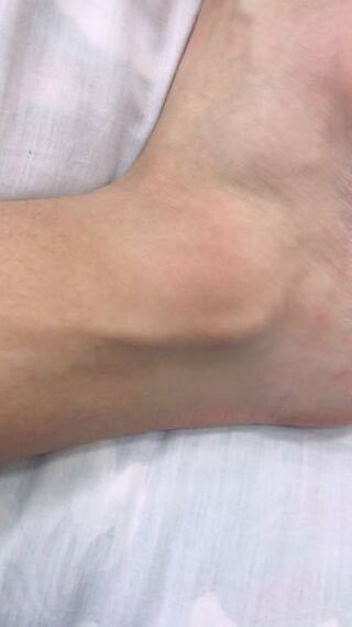 腓骨筋腱脱臼と診断されたのですが この程度なら手術や固定はしなくて大 Yahoo 知恵袋