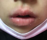 口の周りが荒れにあれて凄いことになってます 画像参照 どうした Yahoo 知恵袋