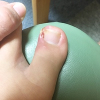 3週間ほど前から足の親指が画像のような状態が続き治りません 靴擦れでしょ Yahoo 知恵袋