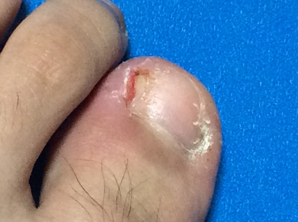 足の爪の端の方が白くなって たまに白い液体が出て来て 押えたり ぶつ Yahoo 知恵袋