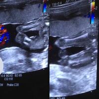 妊娠19週のエコーです 股の写真ですが 性別どちらか分かる方みえますか Yahoo 知恵袋