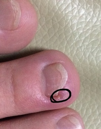 足の爪を切りすぎてしまい写真のようになってしまったのですがどうすれば良い Yahoo 知恵袋