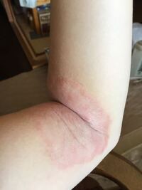 汚いアトピーの腕の写真があるので閲覧注意 私は10年以上アトピー性皮 Yahoo 知恵袋