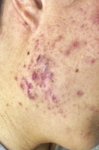 高一男子です 私は1年ほどこめかみからエラにかけてのニキビに悩んでいます Yahoo 知恵袋