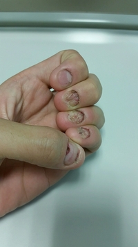 高３です 今までずっと爪を噛む癖があったのですが 頑張って自力 Yahoo 知恵袋