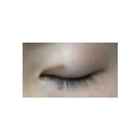 寝ているときに思いっきり擦ってしまったみたいで埋没したところが赤くなって Yahoo 知恵袋