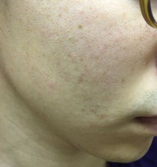肌荒れに悩んでいます ２０歳の男です 頰など顔中が汚いの Yahoo 知恵袋