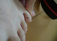 足の指の間にあるのは癌ではないですか 形も左右非対称で足にほくろはできな Yahoo 知恵袋