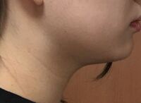 顔の浮腫がひどいです 生理前 生理中体と顔がかなりむくんでしまいます 朝顔 Yahoo 知恵袋