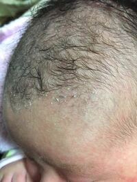 写真あります 生後1ヶ月半の赤ちゃんの頭皮がうろこのようになっています Yahoo 知恵袋