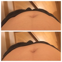 ヘソ下右側だけがボコッと膨らみます これって一体なんでしょう 普段は左右 Yahoo 知恵袋