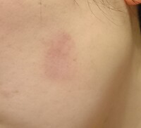 子供が私の顔 頬と額 に吸盤をくっ付けて遊んでいました 別に Yahoo 知恵袋