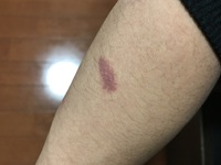 スピチュアルに詳しい方お願いします これは生まれつきの赤痣なの Yahoo 知恵袋