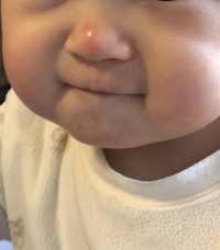 10か月の赤ちゃんについてです今朝からじわじわと鼻が赤くなりました 鼻を Yahoo 知恵袋
