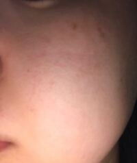 頭皮に茶色いシミっぽいものが6つくらい出来てしまったのですが これは Yahoo 知恵袋